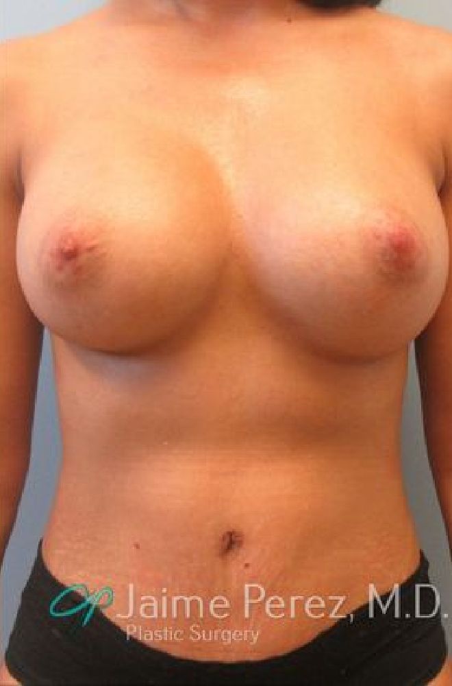 Mommy-Makeover-Case-7653 | After Mommy Makeover