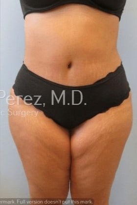 Tummy-Tuck-Case-9973 | After Tummy Tuck