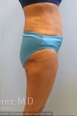 Tummy-Tuck-Case-2372 | After Tummy Tuck