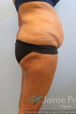 Tummy-Tuck-Case-2372 | Before Tummy Tuck