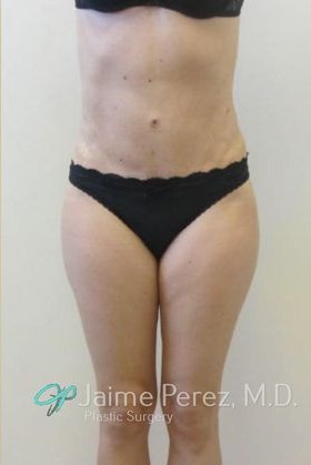 Tummy-Tuck-Case-3789 | After Tummy Tuck